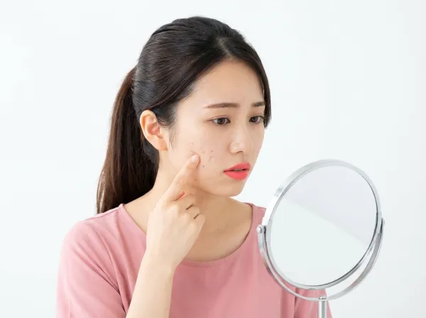 痘疤用雷射真的有效嗎？！徹底解說各種推薦的治療方法