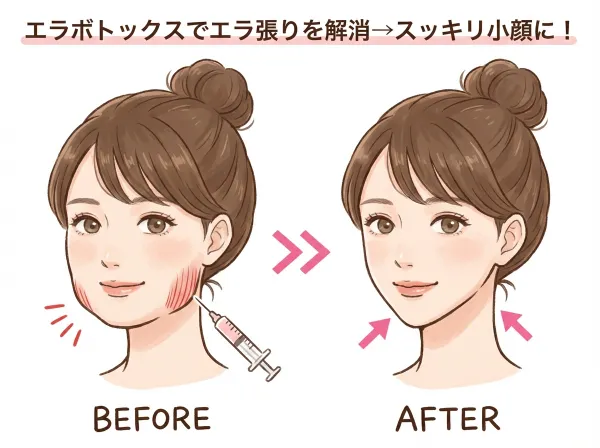 肉毒桿菌注射頻率、持續時間、延長效果的訣竅，全部告訴你