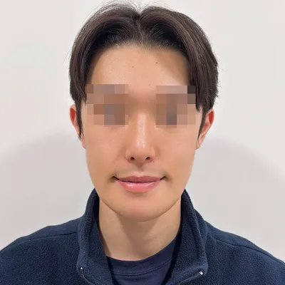 臉部輪廓和隆鼻手術一起做了！