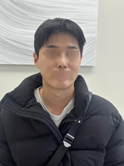 男生鼻部修復心得！！