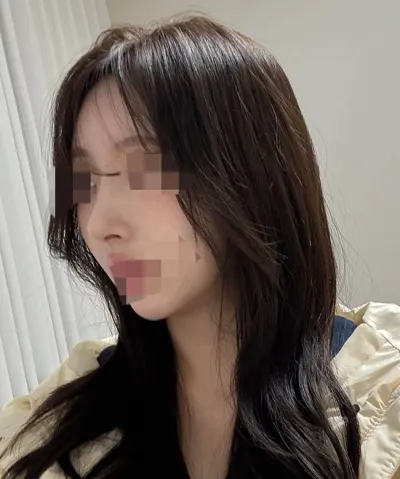 自體肋骨隆鼻大滿意 >< 呵呵