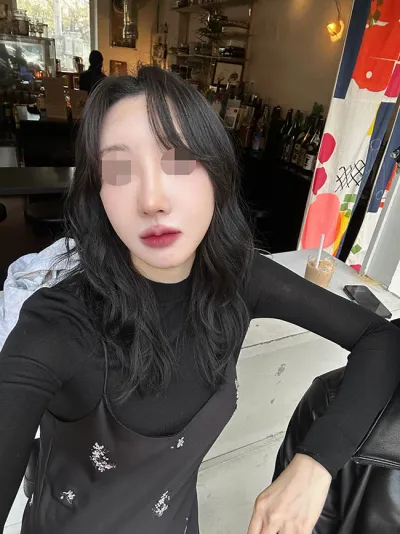 找金賢宇院長做鼻修復（自體肋軟骨）的心得喔