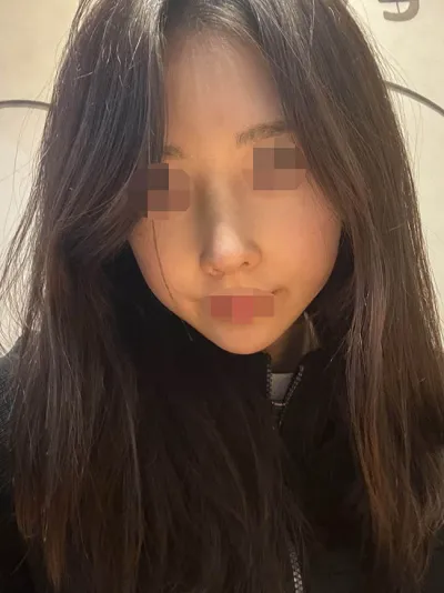 在WANT做了自體肋軟骨隆鼻手術！