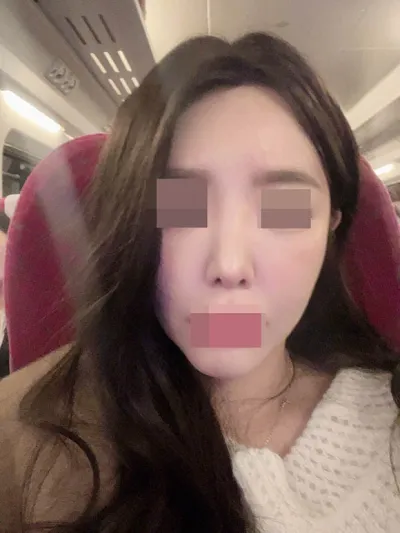 做了鼻修復手術後，自信心也提升了 :)