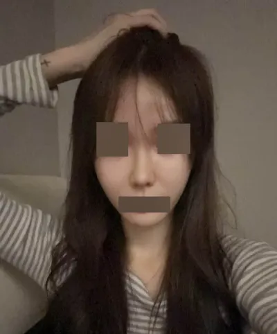 第二次隆鼻在 Want 成功了 ^^