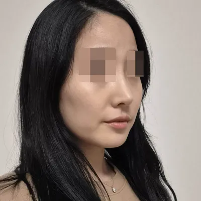 第一次隆鼻是在 Want 做的！（術後第5個月）