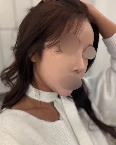 因為想改善低矮歪斜的鼻子，所以決定進行重修手術。