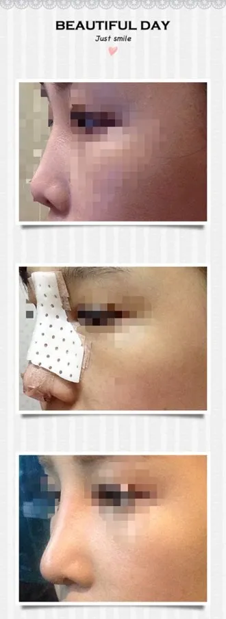 隆鼻第10天！！