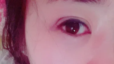 埋線10年後全都鬆開了...ㅠㅠ