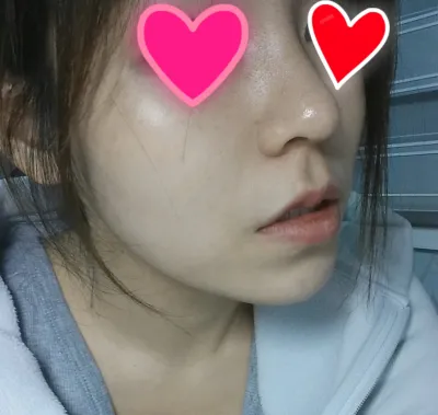 大家好~ 我做完隆鼻手術一個多禮拜，成果太自然了，忍不住來炫耀一下