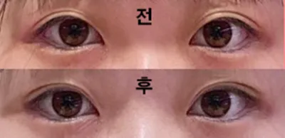 用縫雙眼皮的方式做了手術!