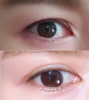 割開眼型矯正超滿意!