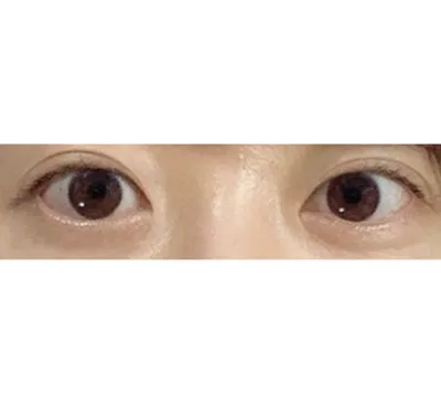 眼型矯正做得太自然啦！