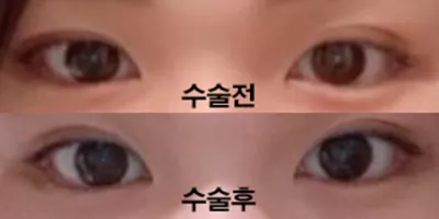 雙眼皮重修術後3個月啦！