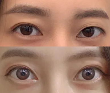 重修手術6個月後記