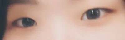 埋線雙眼皮開眼頭後記喔🥰