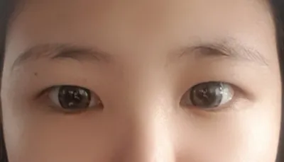 切開眼型矯正4個月後記