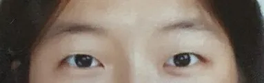 第一次割雙眼皮後記