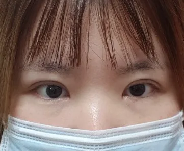 雙眼皮重修、開眼頭拆線後記