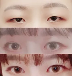 眼型矯正、開眼頭後記