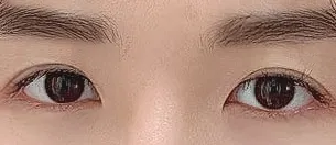 香腸眼皮，太感謝崔東日院長了