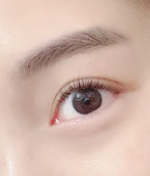 切開眼型矯正!!