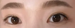 縫雙眼皮很自然喔!