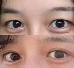 眉毛拉提手術後記