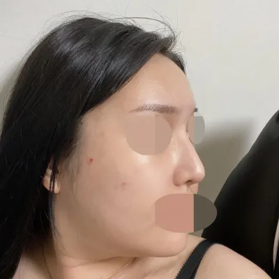 剛拆掉鼻夾時的線條維持得很好，依然很挺。