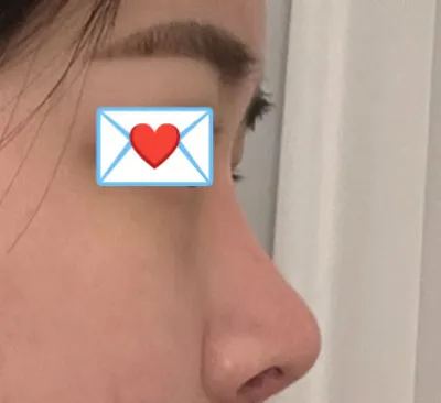 我在 Very Good 整形外科找任榮敏院長做了鼻修復手術！