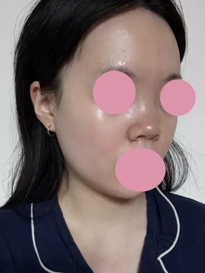 原本鼻子又短又塌，手術效果明顯又自然，我很滿意 :)