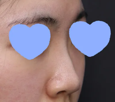 第一次去諮詢就非常滿意，結果連手術日期都定好了，還付了訂金呢..^^