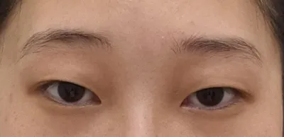 正在考慮做雙眼皮手術的人，不要再到處跑了，快來 Very Good 整形外科諮詢吧(ⓐⓐ) °◇°