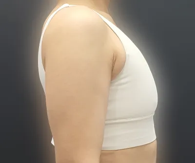 覺得做了真是太好了，其他也讓我困擾的部位也變得更有野心想做了。