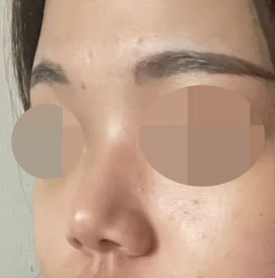因為很在意短鼻子和低鼻樑，所以決定動手術了！