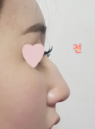 身邊的人也都稱讚我鼻子變得很漂亮喔