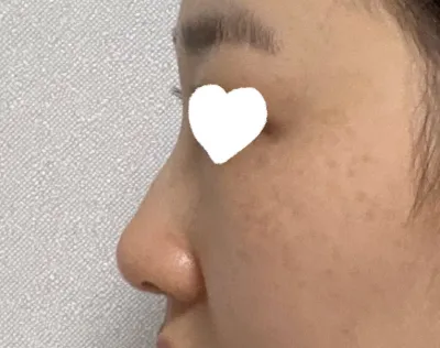 趁著做鼻炎手術的同時，順便修整了鷹鉤鼻並一起進行了鼻部整形手術。