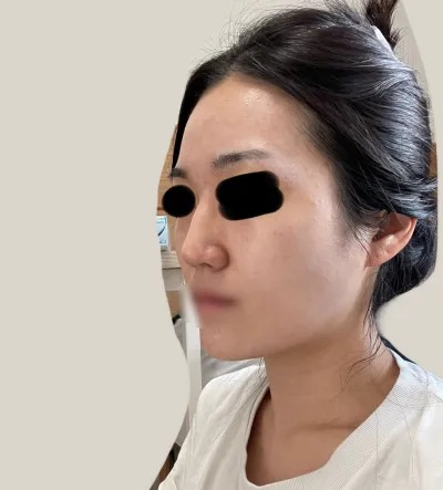 這是術後第5個月。