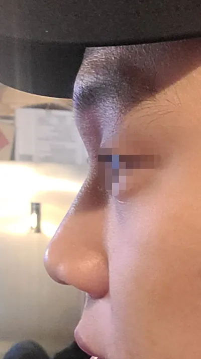 男生鼻子做得真的很好。推薦 Very Good 整形外科。