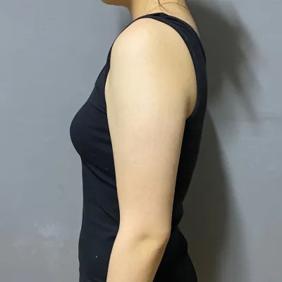 手臂抽脂半年心得！