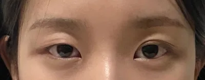 不用貼雙眼皮貼後，生活品質都變不一樣了.. 超滿意的 >_<