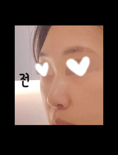 做完功能性隆鼻手術已經進入第4個月了 哈哈