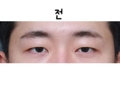 距離在朴相昱院長那裡做手術已經過了5個月左右了。