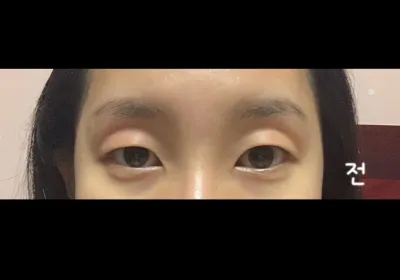 大家一定要去開眼角啊 😭😭