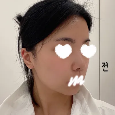 在 Very Good 整形外科做的，已經 5 個月了 ㅎㅎ