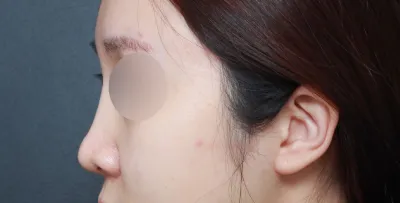 感覺去諮詢鼻部重修手術還是前幾天的事，沒想到時間過得這麼快，已經快六個月了。