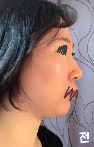 在 Very Good 整形外科做了隆鼻、截骨、下鼻甲、駝峰鼻矯正、鼻翼縮小，到現在已經大約 7 個月了！