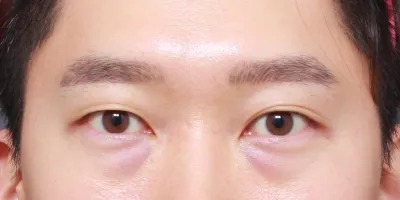 男生眼底脂肪重置心得。