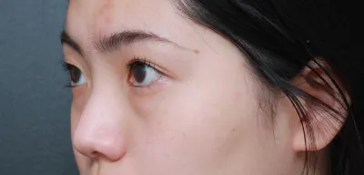 在 Very Good 整形外科做了隆鼻手術（初鼻）、隆鼻術、敲鼻骨、眼下脂肪重新配置！