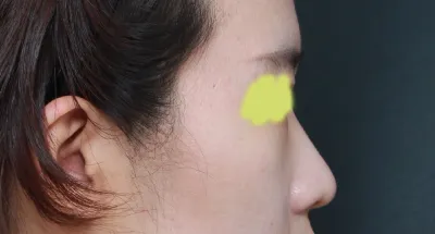 分享第一次隆鼻的心得~